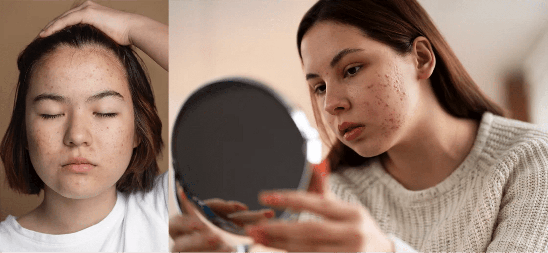 Acné Hormonal y Sus Causas - oby.mx